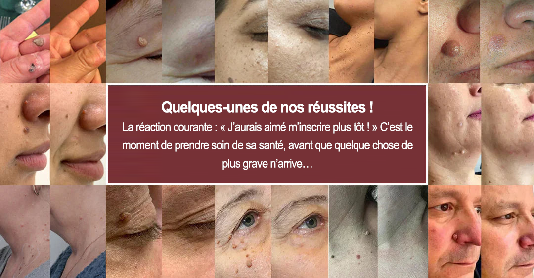 Curalona® Patchs Micro-Aiguilles & Hydrocolloïdes 2-en-1  | Cible les imperfections, verrues planes et acrochordons | Invisible • Facile à utiliser • Visage & Corps