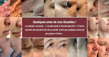 Curalona® Patchs Micro-Aiguilles & Hydrocolloïdes 2-en-1  | Cible les imperfections, verrues planes et acrochordons | Invisible • Facile à utiliser • Visage & Corps