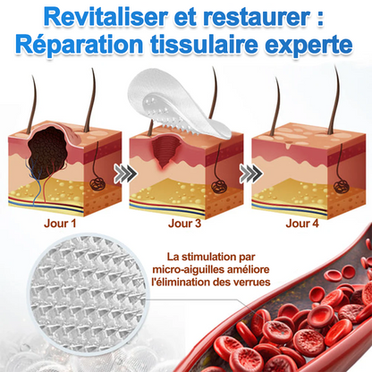 Curalona® Patchs Micro-Aiguilles & Hydrocolloïdes 2-en-1  | Cible les imperfections, verrues planes et acrochordons | Invisible • Facile à utiliser • Visage & Corps